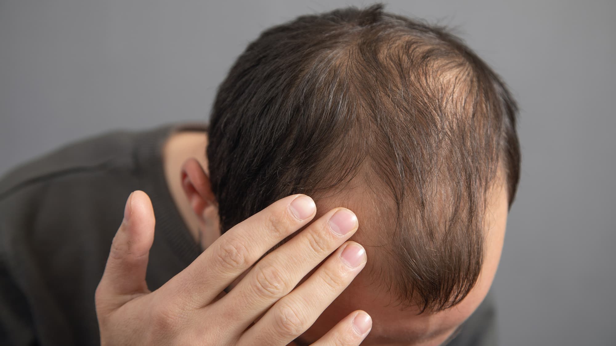 Hair loss after gadolinium MRI contrast